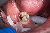 Dental caries in a molar