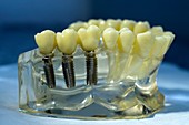 Dental implants,model