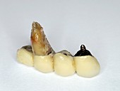 Extracted tooth with bridge