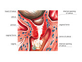 Cervix in pregnancy,illustration