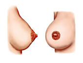 Postpartum breasts,illustration