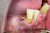 Decayed premolar tooth