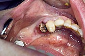 Root of a decayed tooth