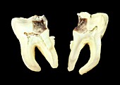 Decayed tooth structure