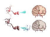 Healthy and Alzheimer's brains