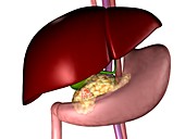 Pancreatic cancer,illustration