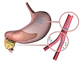 Type 1 diabetes,illustration