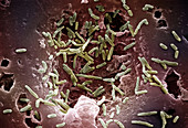 Mycobacterium Chelonae