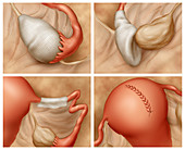 Uterine Procedures
