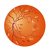 Retina With Hypertension