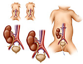 Kidney Transplant in Child