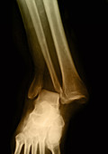 Fractured Ankle