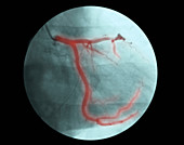 'Left Coronary Artery,(LCA)'