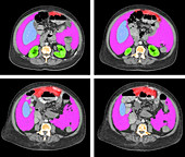 Abdominal Pain CT