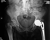 Hip Fracture and Hip Replacement