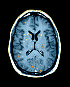 Metastatic brain cancer,MRI scan