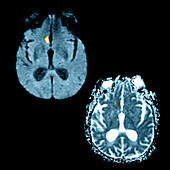 MRI of Stroke