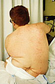 Male patient with spina bifida