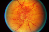 Retinal Papilledema