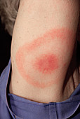 Lyme Disease Bullseye
