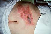 Shingles rash