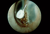 Ear with Cholesteatoma