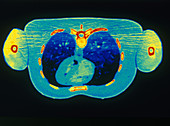 'Chest & Heart,CT Scan'
