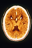 'Brain,CT Scan'