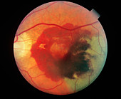 Retinal Hemorrhage (3 of 3)