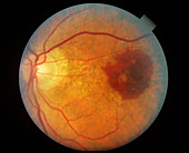 Retinal Hemorrhage (1 of 3)