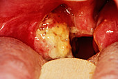 Infected tonsils