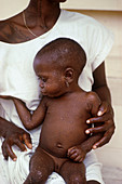 Baby with smallpox