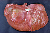 Liver wth Tumor