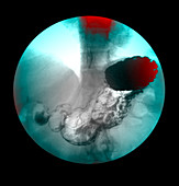 Normal Upper GI Series