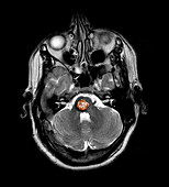 Cranial Vascular Malformation
