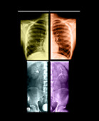 Composite X-rays of Kidneys and Pneumonia