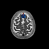 Color Enhanced MRI of Falx Meningioma