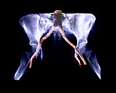 X-ray of Pelvis with Arteries