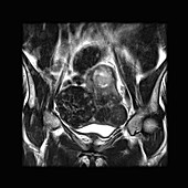 'Uterine Fibroids,MRI'