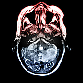 Cerebellar Infarcts on MRI
