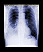 'Pneumonia & Pleural Effusion,X-Ray'