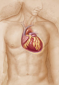 Enlarged Heart