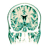 Normal Coronal MRI of the Brain