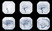 Cerebral Angiogram