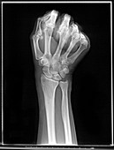 'Wrist,X-Ray (Scaphoid View)'