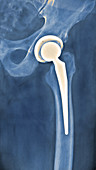 'Total Hip Replacement,X-Ray'