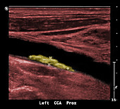 Atherosclerosis of the Carotid Artery