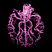 Intracranial CT Angiogram