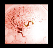 Serpentine Aneurysm