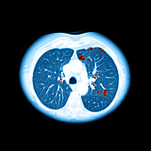 Emphysema on CT Chest